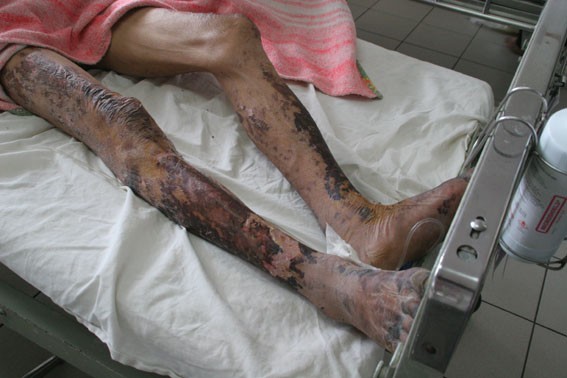 Người bệnh nhiễm khuẩn liên cầu lợn có thể bị hoại tử chân tay.